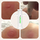Insect Bug Bee Sting Extractor Suction Tool